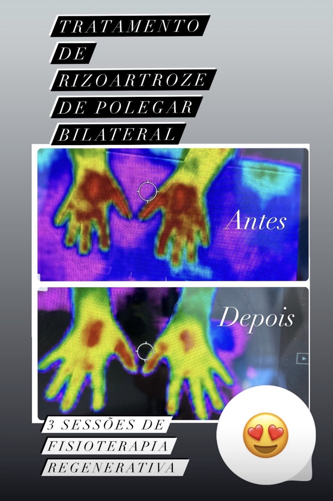 Registro termográfico de acompanhamento de rizoartrose de polegar